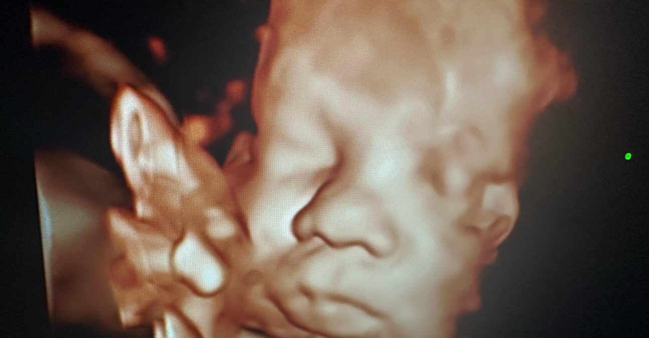 Iğdır Renkli Ultrason